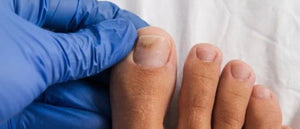 Ursache Nagelpilz